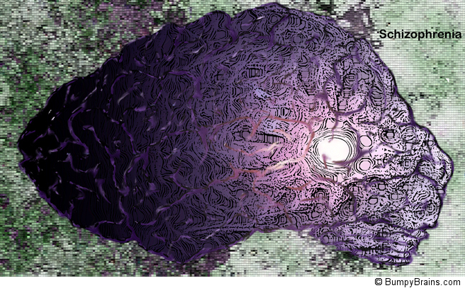 Schizophrenia Brain