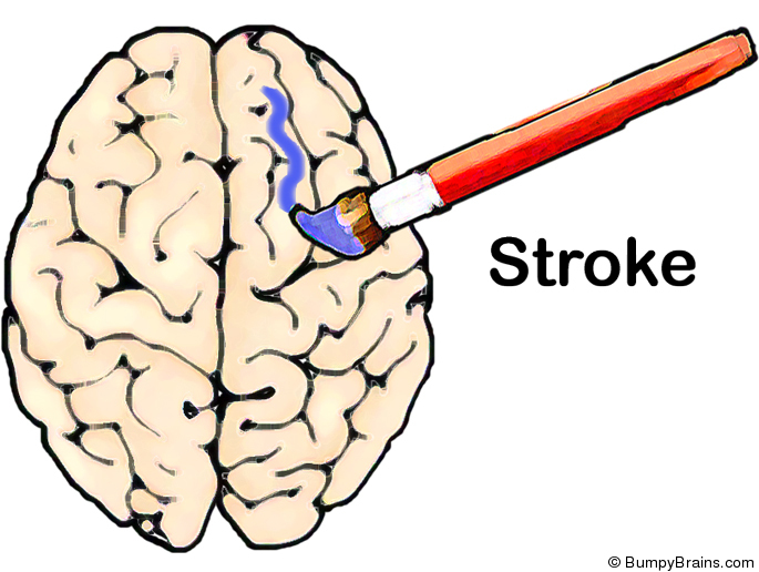 Stroke